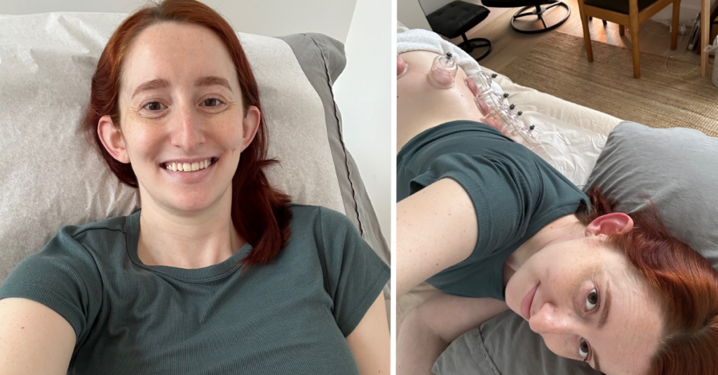 I Tried Acupuncture and Cupping for the 1st Time at 36 Weeks Pregnant — Here's How It Went
